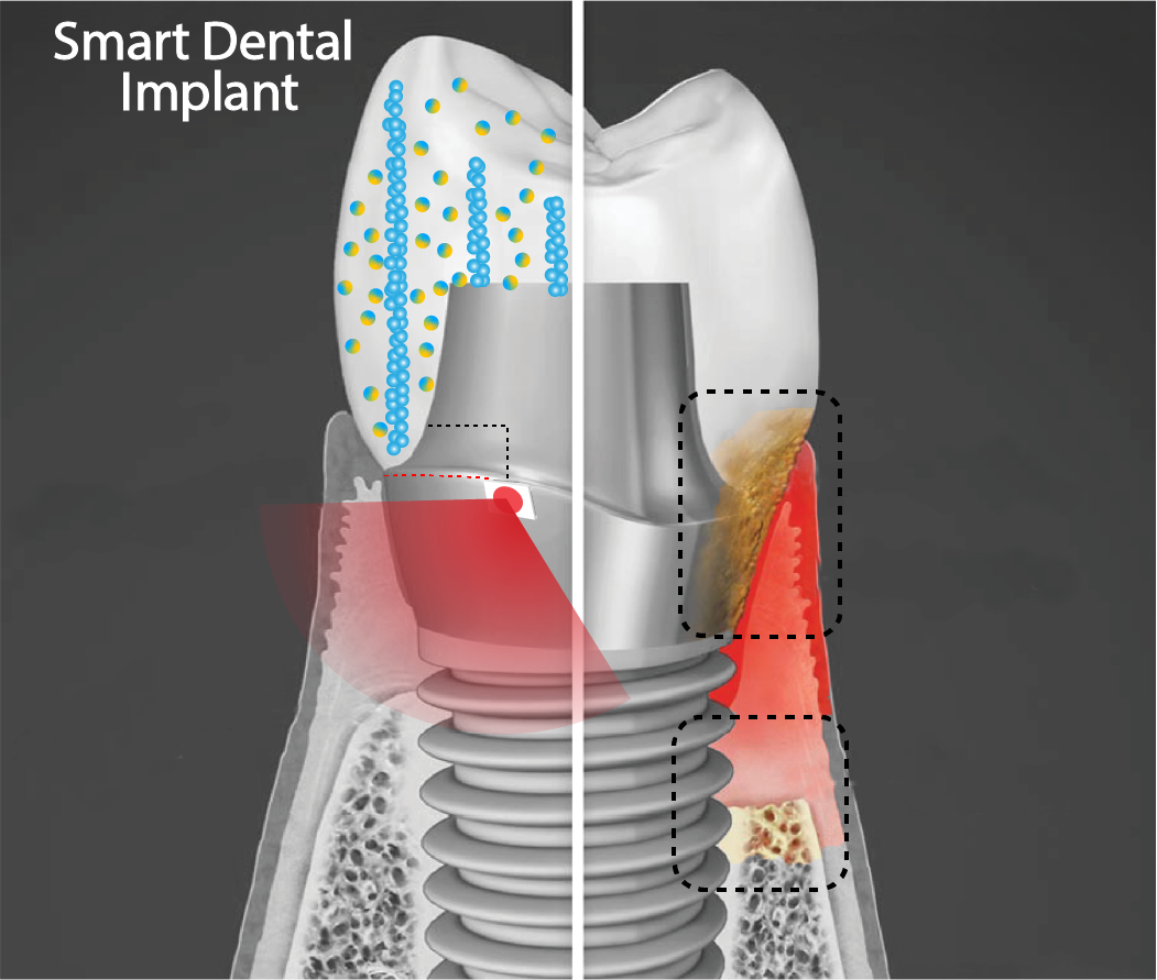 Image of a smart dental implant, involving new tooth screwed into bone