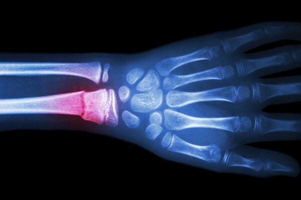 X-ray of wrist with broken bone